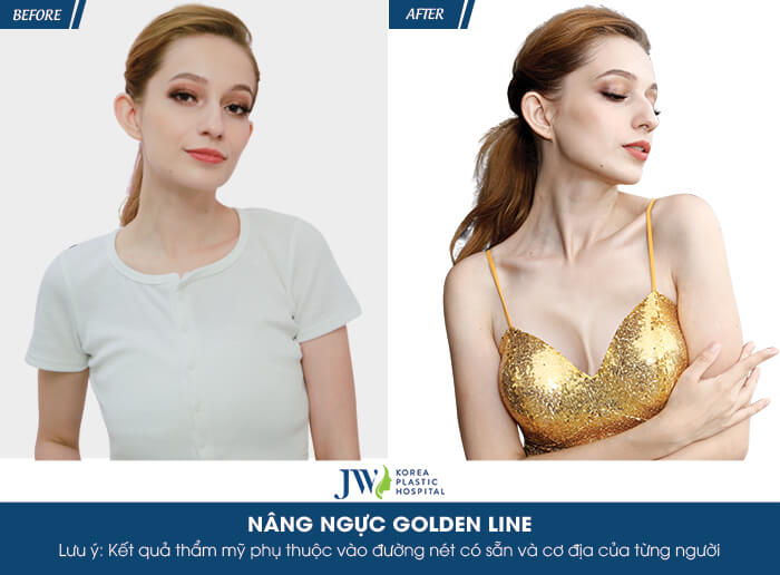 Sử dụng công nghệ nâng ngực Golden Line kiến tạo lại vẻ đẹp của bạn 