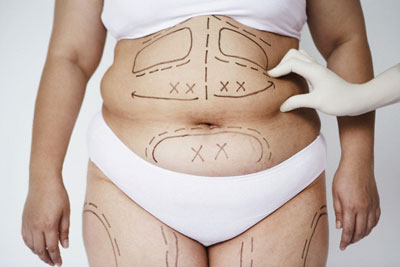 Phẫu thuật căng da bụng cần được xác định tỉ lệ ngay từ ban đầu
